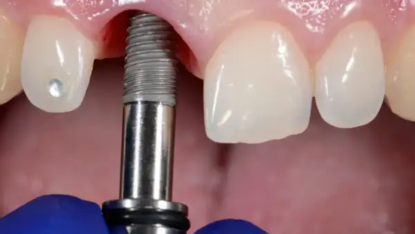 Zabieg wszczepienia implantu dentystycznego w szczękę. Widoczne narzędzie stomatologiczne i fragment implantu.