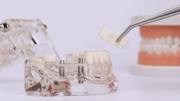 Model szczęki z implantami i mostkiem. Szukasz najtańszych implantów zębowych w Polsce?