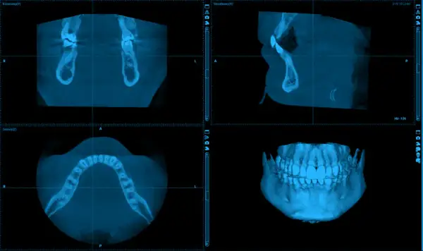 Trzy obrazy tomograficzne żuchwy: przekrój czołowy, boczny i osiowy, oraz trójwymiarowy model szczęki. Rak żuchwy zdjęcia diagnostyczne.