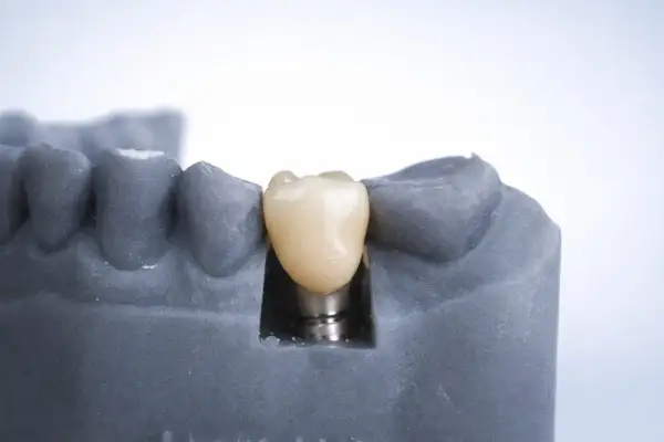 Model szczęki z implantem zębowym. Zastanawiasz się, ile kosztuje implant zęba 6? To inwestycja w Twój uśmiech.