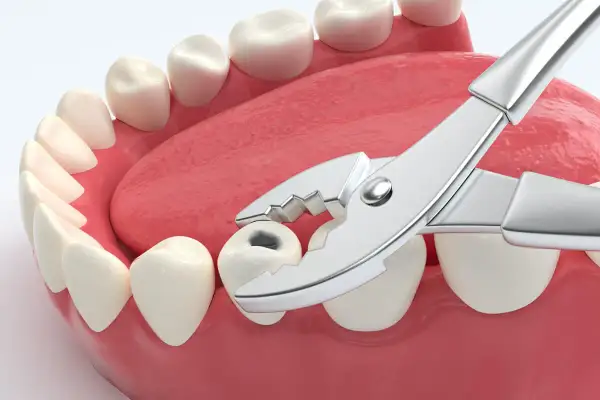 Zastanawiasz się, ile kosztuje wyrwanie zęba? Widok kleszczy dentystycznych przygotowanych do ekstrakcji zepsutego zęba.