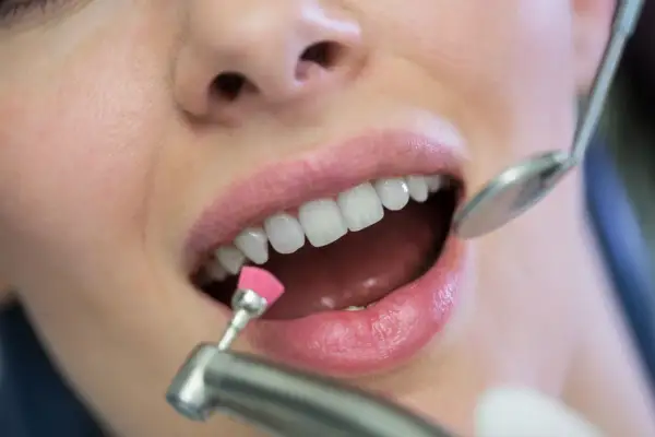 Zabieg fluoryzacji z użyciem szczoteczki i lusterka dentystycznego.