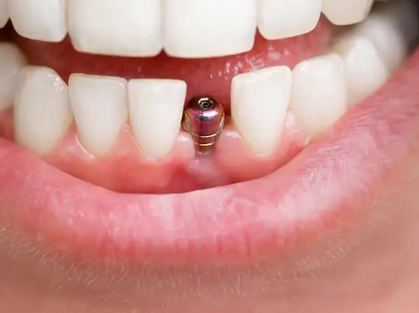 Implant zęba przed i po: metalowy filar wystaje z dziąsła, czekając na koronę.