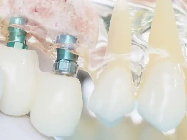 Model szczęki z implantami i koronami. Widoczne są metalowe śruby i białe zęby, sugerujące odrzucenie implantu zęba.