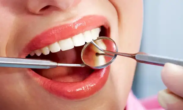 Uśmiech z błyszczącymi zębami, badany lusterkiem dentystycznym. Czy bonding jest odwracalny? To pytanie nurtuje wielu pacjentów.