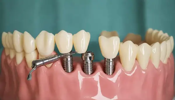 Model szczęki z implantami zębów i narzędziem. Sprawdź nasz cennik implantów zębów.