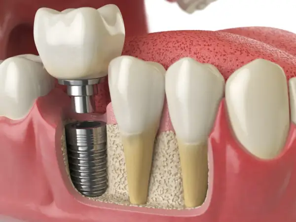 Przekrój przez szczękę pokazujący implant zęba, jego śrubę w kości i koronę. Zastanawiasz się, ile kosztuje implant zęba?