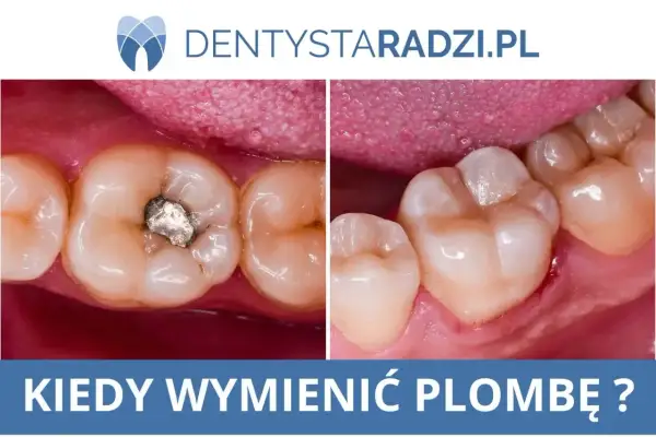 Porównanie zęba ze starą, metalową plombą i zęba po wymianie na nową, estetyczną. Kiedy wymienić plombę?