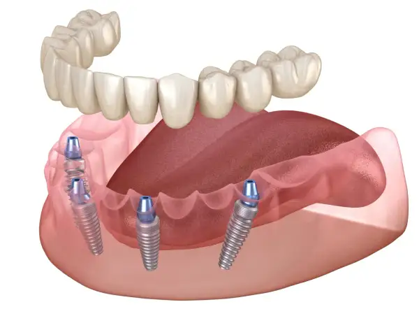 Górna proteza zębowa opiera się na implantach wszczepionych w dolną szczękę.
