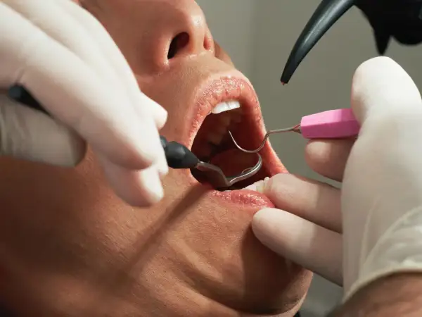 Dentysta używa lusterka i narzędzi do odbudowy zęba.