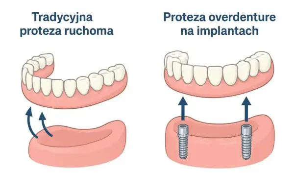Porównanie protezy ruchomej i protezy overdenture na 2 implantach. Sprawdź proteza overdenture na 2 implantach cena.