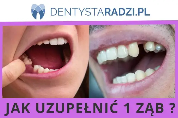 Uzupełnienie 1 zęba jedynki na NFZ. Widok otwartych ust z brakującym zębem.