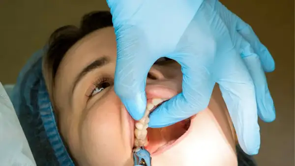Dentysta w niebieskiej rękawiczce delikatnie podtrzymuje policzek pacjentki, pokazując zęby. Pytanie brzmi, po jakim czasie rozpuszczają się szwy.