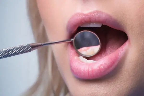 Usta kobiety z lusterkiem dentystycznym badającym zęby, uwidaczniające początki demineralizacji szkliwa.