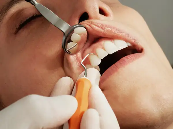 Dentysta wykonuje skaling, czyli usuwa kamień nazębny. Widoczne narzędzia stomatologiczne i usta pacjenta.