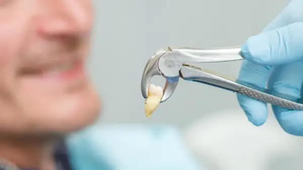 Dentysta trzyma wyjęty ząb w kleszczach. Czy po wyrwaniu zęba można iść do pracy? Zależy od samopoczucia.