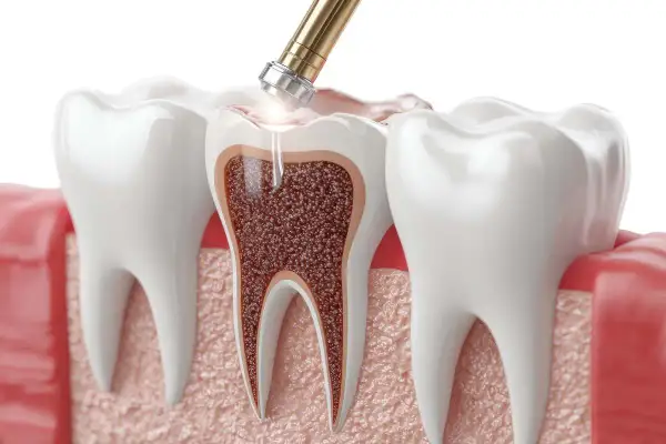 Ból zęba 5 lat po leczeniu kanałowym? Zobacz, jak wygląda wnętrze zęba i co może być przyczyną nawracającego bólu.