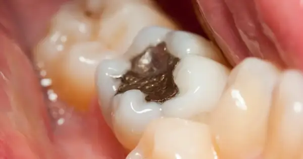 Zbliżenie na ząb z ciemną, metaliczną plombą. Widać też inne zęby i fragment dziąsła.