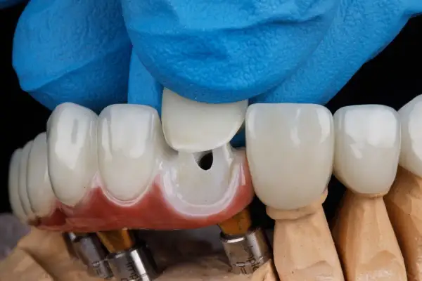 Dłoń w niebieskiej rękawiczce dopasowuje ceramiczną koronę zęba do modelu.
