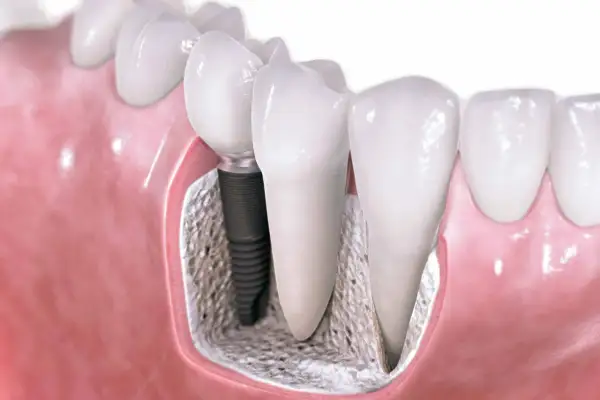 Implant stomatologiczny w kości, obok naturalnego zęba. Sprawdź, jaka jest most na implantach cena.