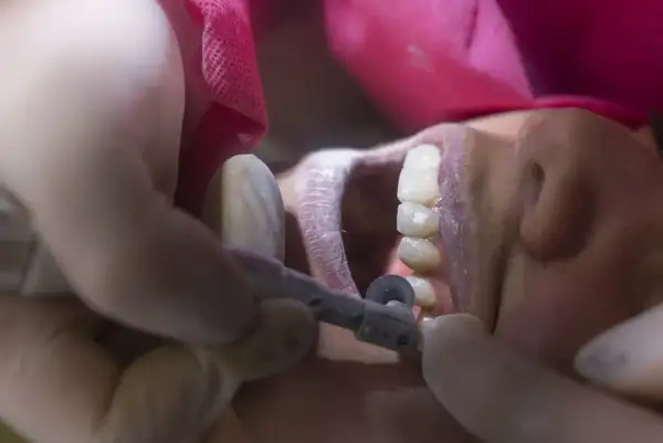 Dentysta wygładza ostry brzeg kości po usunięciu zęba, używając małego wiertła.