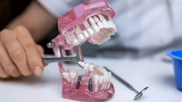 Model szczęki z implantami, gdzie pęsetą umieszczany jest nowy ząb. Pokazane jest wstawienie zęba.
